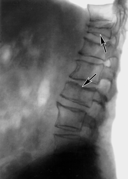 Рис. 1. Рентгенограмма поясничного отдела позвоночника (боковая проекция) больного с системным остеопорозом: отмечается снижение рентгенологической плотности тел позвонков (остеопения), склероз субхондральных пластинок и вдавленные переломы в их центральных отделах (указаны стрелками)