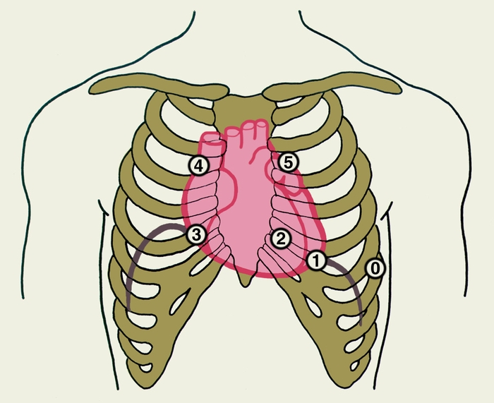 Рис. 1. Схема расположения на грудной клетке точек установки микрофона для записи фонокардиограммы: 0 — «нулевая» точка (V межреберье по передней аксиллярной линии слева), 1 — точка, соответствующая примерно верхушке сердца (V межреберье по левой среднеключичной линии), 2 — точка проекции митрального клапана (IV межреберье у левого края грудины), 3 — точка проекции трехстворчатого клапана (IV межреберье у правого края грудины), 4 — точка проекции аортального клапана (II межреберье справа от грудины), 5 — точка проекции клапана легочного ствола (II межреберье слева от грудины)