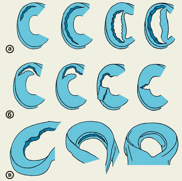 Рис. 1. Схематическое изображение некоторых видов повреждения менисков: а — продольные разрывы; б — поперечные разрывы; в — дегенеративные и горизонтальные разрывы