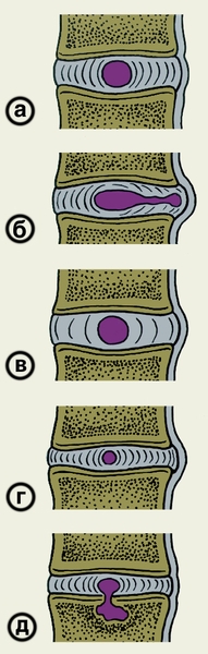Рис. 1. Схематическое изображение различных вариантов патологических изменений межпозвоночного диска: а — нормальный межпозвоночный диск (приведен для сравнения); б — протрузия диска в результате перемещения части студенистого ядра и выпячивание фиброзного кольца в позвоночный канал; в — протрузия диска в результате повышения его гидрофильности; г — протрузия диска в результате его обезвоживания; д — внутригубчатая грыжа диска
