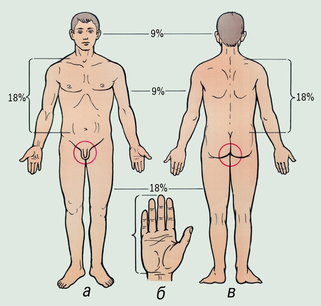 Определение площади ожога по «правилу ладони» и «правилу девяток»: площадь ладони (б) составляет примерно 1% от общей площади поверхности тела; площадь поверхности головы и шеи составляет примерно 9%, передней (а) и задней (в) поверхности туловища — по 18% и т.д