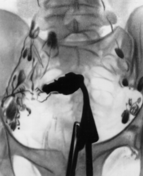 Рис. 13. Гистеролимфограмма при раке тела матки, занимающем всю ее полость, с метастазами в подвздошных лимфатических узлах с обеих сторон