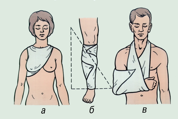 Рис. 4. Косыночная повязка на правую молочную железу (а), на <a href=