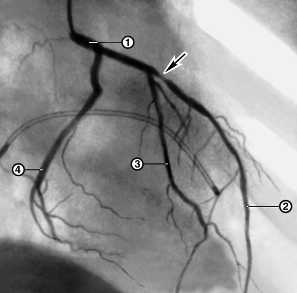Рис. 2а). Ангиограмма ствола (1) и ветвей левой коронарной артерии (2 — передняя межжелудочковая артерия, 3 — диагональная артерия, 4 — огибающая артерия) больного со стенокардией напряжения: до лечения (стрелкой указано место резко выраженного, примерно на 90%, проксимального стеноза передней межжелудочковой артерии)