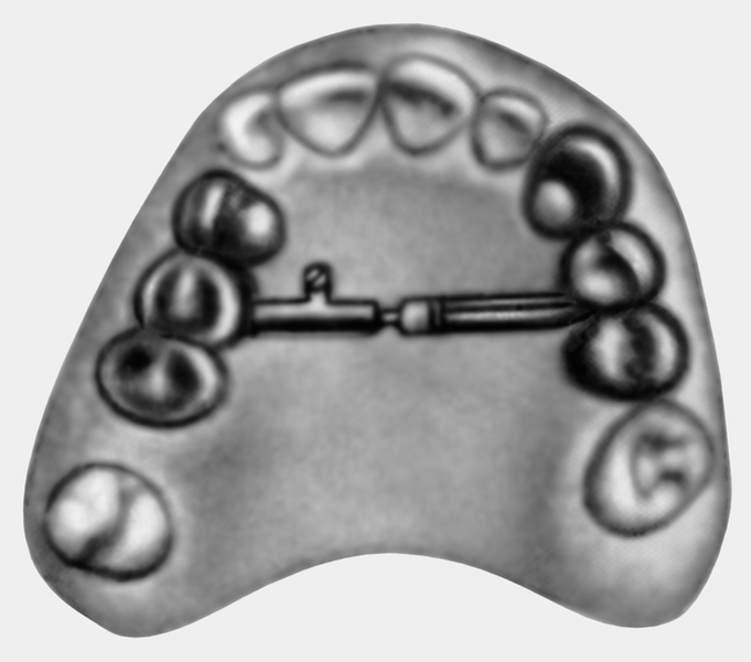Рис. 1. Две несъемные стальные каппы, соединенные винтом для расширения зубных дуг