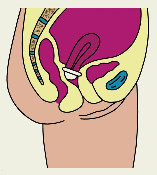Рис. 2. Схематическое изображение шеечного колпачка, надетого на шейку матки (на саггитальном разрезе малого таза женщины)