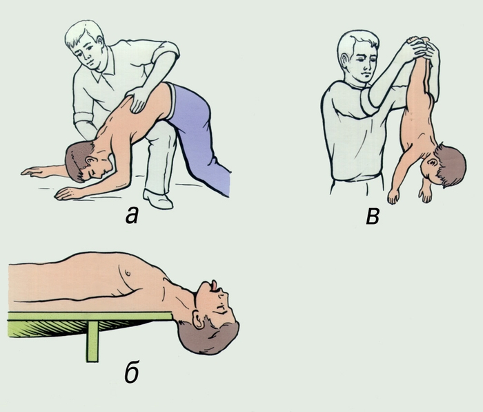 Рис. 1. Удаление инородного тела из дыхательных путей: а, б — пассивное удаление; в — положение пострадавшего для активного удаления инородного тела