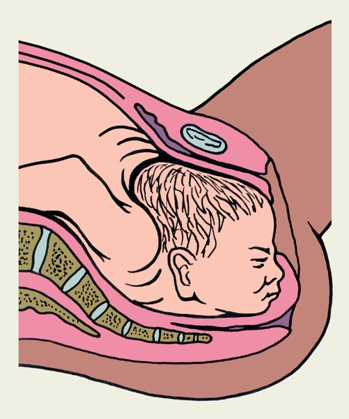 Рис. 17. Схематическое изображение варианта вставления головки плода при лицевом предлежании — затылок плода обращен к лобковому симфизу (роды невозможны)