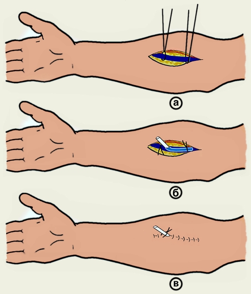 Схематическое изображение отдельных этапов веносекции: а — <a href=