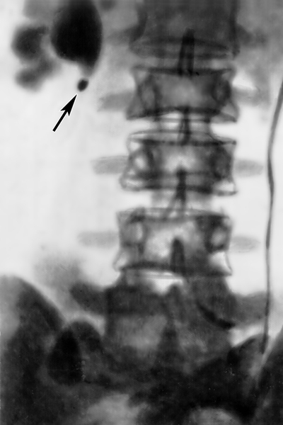 Рис. 6. Экскреторная урограмма при мочекаменной болезни: тень камня прилоханочного отдела правого мочеточника (указана стрелкой), гидронефроз