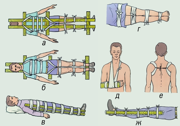 Иммобилизация при помощи подручных средств: а, б — при переломе позвоночника; в, г — иммобилизация бедра; д — предплечья; е — ключицы; ж — голени