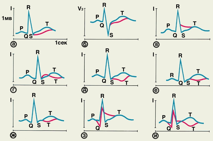 Рис. 9(а—и). Схематическое изображение изменений ЭКГ при стенокардии, очаговой дистрофии и инфаркте миокарда разной локализации (иллюстрации к табл. 1): синяя кривая — нормальная ЭКГ, красные кривые — патологически измененные ЭКГ