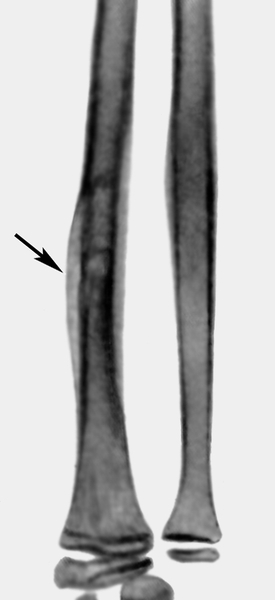 Рис. 10а). Рентгенограмма предплечья ребенка 11 лет с острым гематогенным остеомиелитом: участок деструкции в лучевой кости с периостальными наложениями (указан стрелкой)