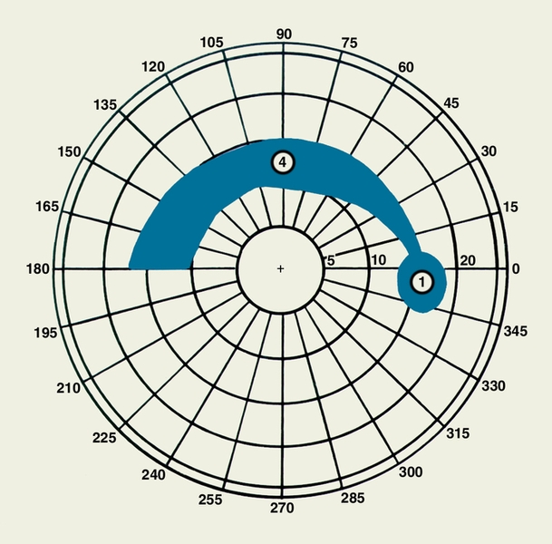 Рис. в). Изображение патологических скотом на скотометрических схемах при исследовании поля зрения правого глаза (крестиком обозначена точка фиксации): 1 — слепое пятно; 4 — скотома Бьеррума, сливающаяся со слепым пятном