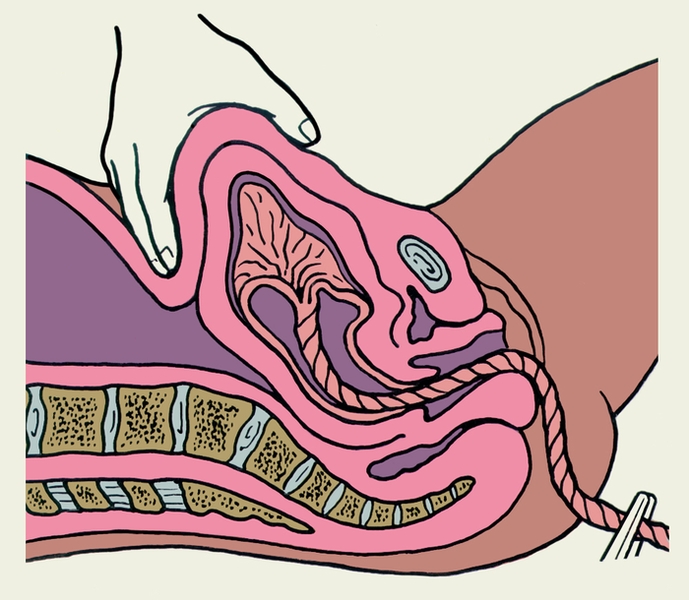 Рис. 13. Схематическое изображение проведения приема Креде-Лазаревича с целью выделения последа при отделившейся плаценте: дно матки, выведенное к средней линии живота, захватывают рукой так, чтобы большой палец располагался на передней поверхности матки, а четыре других на задней; сжимая пальцы, надавливают на дно матки в направлении к крестцу