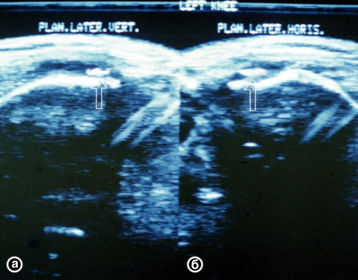 Рис. 26. Ультрасонограмма коленных суставов (продольный <a href=