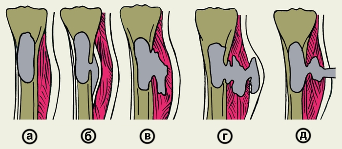 Рис. 7. Схема формирования гнойного свища при переходе острого гематогенного остеомиелита большеберцовой кости в хронический: а — абсцесс костного мозга; б — поднадкостничный абсцесс; в — межмышечная флегмона; г, д — этапы самостоятельного прорыва гноя с образованием свища