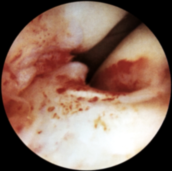 Рис. 17. Артроскопическая картина при кровоизлиянии в переднюю крестообразную связку