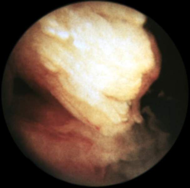 Рис. 19. Артроскопическая картина при полном разрыве передней крестообразной связки