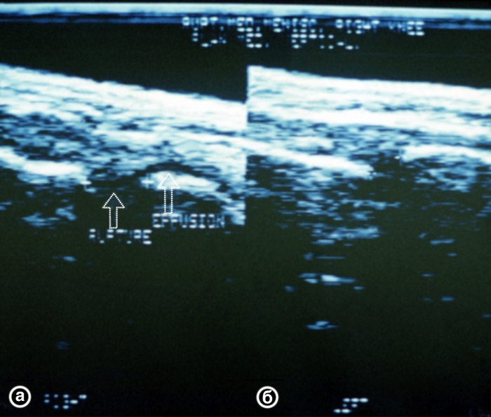 Рис. 27. Ультрасонограммы левого коленного сустава (а — латеральный вертикальный срез, б — горизонтальный срез) при трансхондральном переломе наружного мыщелка бедренной кости: область перелома указана стрелками