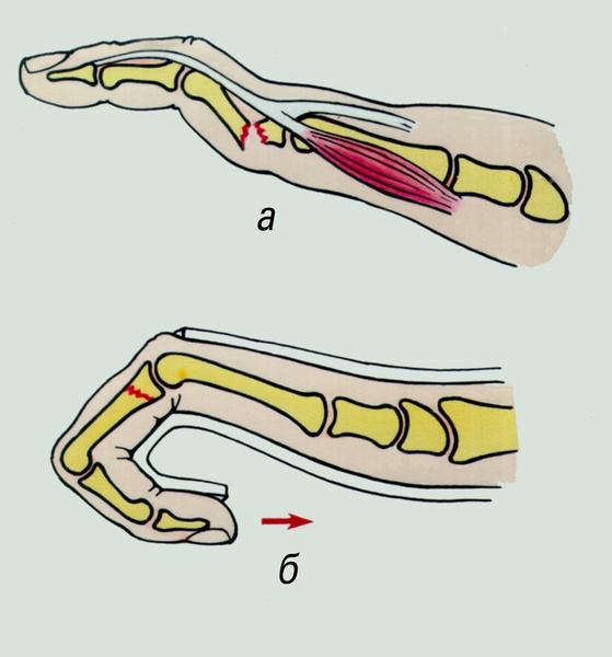 Рис. 4. Перелом фаланги с образованием угловой деформации вследствиие тяги межкостных и червеобразных мышц (а) и иммобилизация поврежденного пальца в положении сгибания (б)