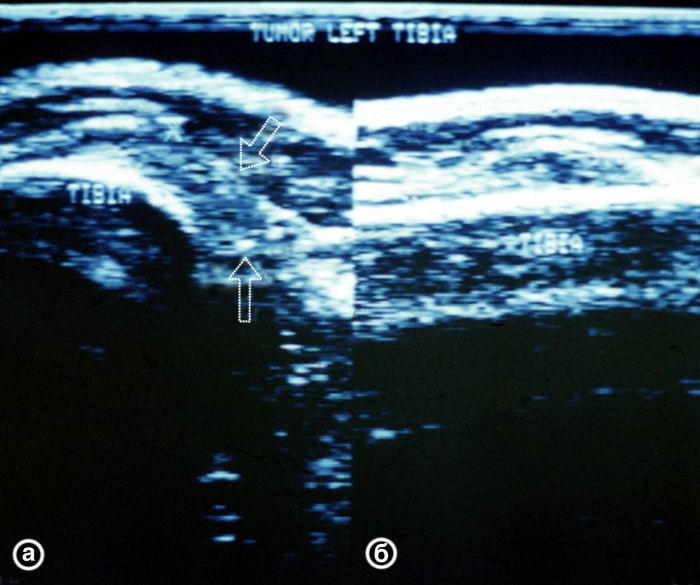 Рис. 28. Ультрасонограммы верхней трети левой голени (а — поперечная, б — продольная проекции) при околосуставной мягкотканной опухоли: опухоль указана стрелками