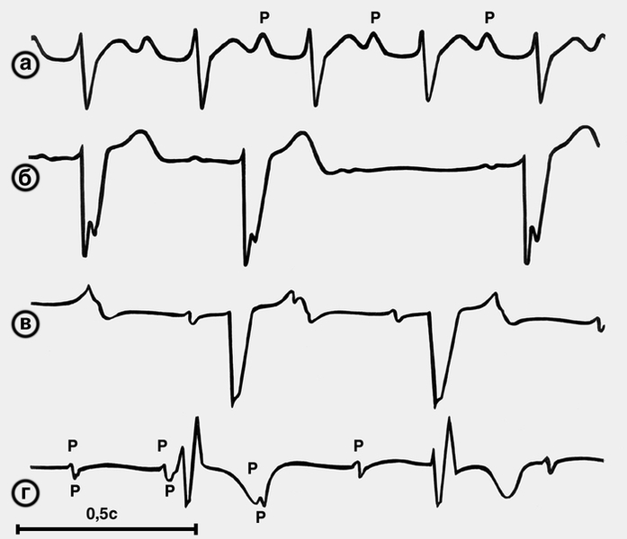 Рис. 2. Электрокардиограммы (внизу масштаб времени — 0,5 с) при атриовентрикулярной блокаде: а — блокада I степени; интервал Р—Q до 0,28 с; б — блокада II степени, <a href=