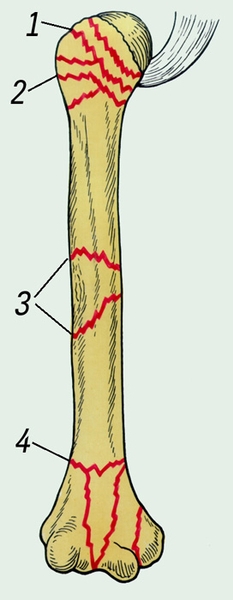 Рис. 1. Варианты типичных переломов плечевой кости: 1 — чрезбугорковые; 2 — хирургической шейки; 3 — диафизарные; 4 — над- и чрезмыщелковые