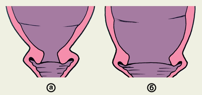 Рис. 2. Схематическое изображение этапов раскрытия шейки матки у повторнородящей: а — одновременное сглаживание и раскрытие шейки матки (внутреннего и наружного зева); б — полное раскрытие шейки матки