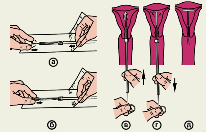 Рис. 5. Схематическое изображение основных этапов введения Т-образного медьсодержащего контрацептива (Си T-200) в полость матки: а, б — введение контрацептива в шприц-проводник с цервикальной меткой; в, г — продвижение контрацептива в полость матки и расправление его плечиков; д — правильное положение контрацептива в полости матки после извлечения шприца-проводника