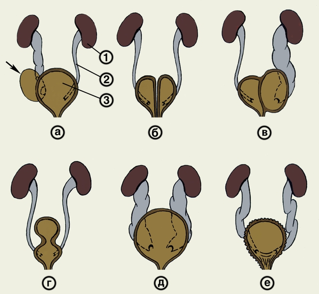 Рис. 3. Схематическое изображение органов мочевой системы при некоторых пороках развития мочевого пузыря: а — <a href=