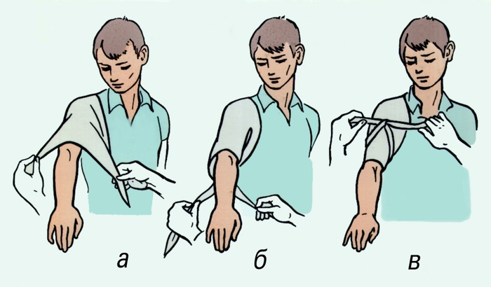 Рис. 1. Наложение косыночной повязки на плечо и плечевой сустав: а, б, в — этапы наложения повязки