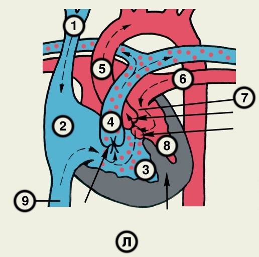Рис. 23л). Схематическое изображение отдельных врожденных пороков сердца (направления кровотока обозначены пунктирными стрелками, локализация пороков — сплошными стрелками): тетрада Фалло — стеноз легочного ствола, сочетающийся с декстропозицией аорты, дефектом межжелудочковой перегородки и гипертрофией правого желудочка; 1 — верхняя полая вена, 2 — правое предсердие, 3 — правый желудочек, 4 — легочный ствол, 5 — аорта, 6 — легочная вена, 7 — левое предсердие, 8 — левый желудочек, 9 — нижняя полая вена
