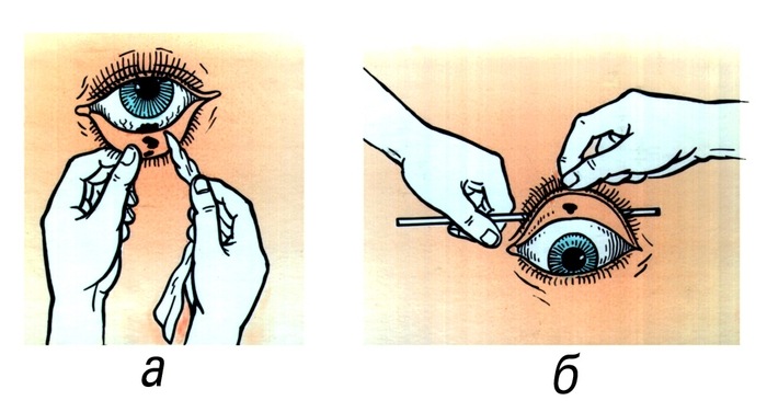 Рис. 1. Удаление инородного тела из глаза: а — из-под нижнего века; б — из-под верхнего века