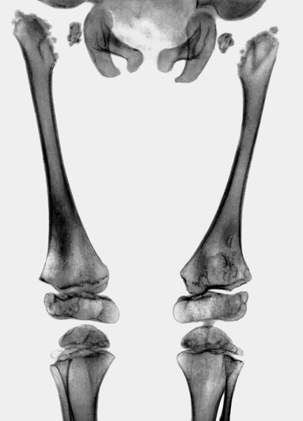 Рис. 13. Рентгенограмма тазобедренных суставов бедер и коленных суставов при врожденной спондилоэпифизарной дисплазии: головки бедренных костей представлены мелкими хлопьевидными фрагментами, определяется варусная деформация шеек бедренных костей