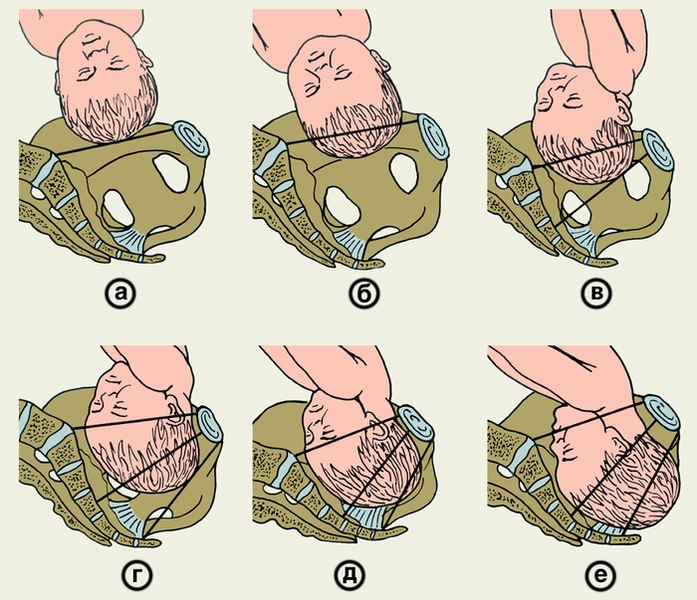 Рис. 9. Схематическое изображение положения головки плода по отношению к плоскостям малого таза: а — головка над входом в малый таз; б — головка малым сегментом во входе в малый таз; в — головка большим сегментом во входе в малый таз; г — головка в широкой части полости малого маза; д — головка в узкой части полости малого таза; е — головка в выходе малого таза; I — <a href=