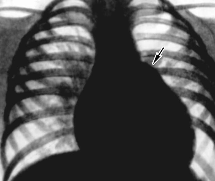Рис. 26. Рентгенограмма грудной клетки больного с дефектом межжелудочковой перегородки (прямая проекция): тень сердца увеличена за счет обоих желудочков, заметное выбухание дуги легочного ствола (указано стрелкой), легочный рисунок в прикорневых отделах легких усилен