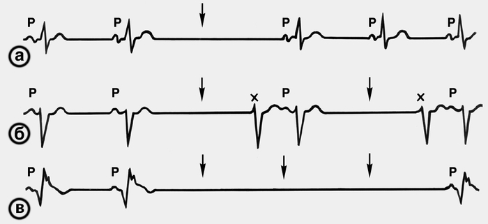 Рис. 1. Электрокардиограммы (внизу масштаб времени — 1 с) при синоаурикулярной блокаде. Синусовый ритм нарушается паузами за счет выпадения отдельных предсердно-желудочковых комплексов (стрелками указаны предполагаемые места зубца Р выпавших комплексов PQRST): а — выпадение одного комплекса, за счет чего интервал между вторым и третьим комплексами удваивается; б — повторяющиеся выпадения предсердно-желудочкового комплекса (блокада 2:1) с появлением «выскакивающих»комплексов замещающего ритма из атриовентрикулярного соединения (отмечены крестиком) после каждого выпадения; в — резкое замедление проведения импульса из синусового узла, предшествующее асистолии («арест» синусового узла)