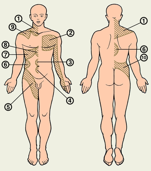 Схема расположения зон Захарьина — Геда на туловище и конечностях. В указанных зонах могут появляться боль и гиперестезия при заболеваниях легких и бронхов (1), сердца (2), кишечника (3), мочевого пузыря (4), мочеточников (5), почек (6), печени (7 и 9), желудка и поджелудочный желеэы (8), мочеполовой системы (10)