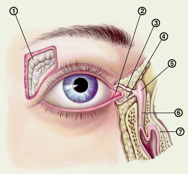 Рис. 1. Топография слезных органов: 1 — слезная железа; 2 — слезное мясцо; 3, 4 — слезные канальцы; 5 — слезный мешок; 6 — носослезный проток; 7 — нижняя носовая раковина