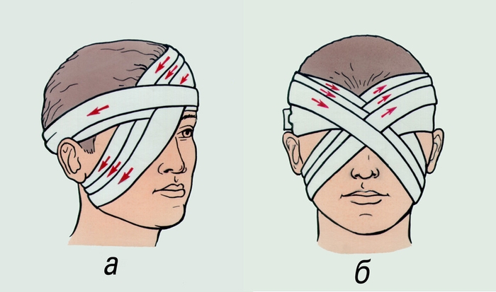 Рис. 3. Наложение повязки на один глаз (а) и на оба глаза (б). Стрелками показано направление бинтования и последовательность круговых туров
