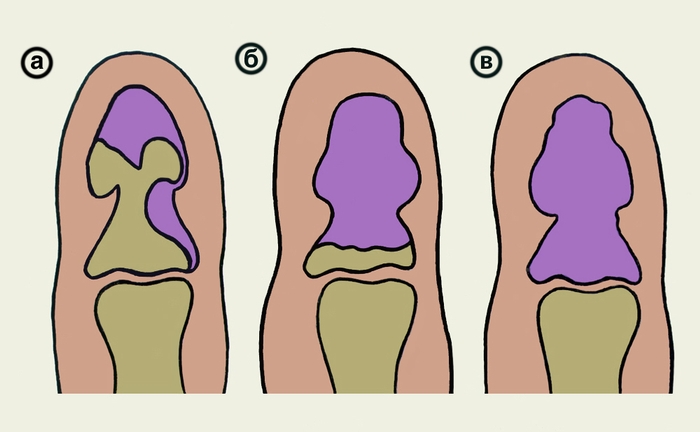 Рис. 5. Схематическое изображение деструкции и секвестрации кости при костном панариции: а — краевая; б — субтотальная; в — тотальная