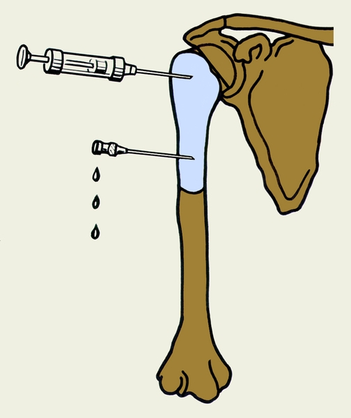 Рис. 5а). Схематическое изображение пункции кисты кости (а) и множественной перфорации ее стенки (б)