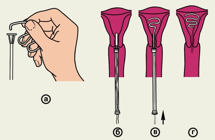 Рис. 4. Схематическое изображение основных этапов введения петли Липпса в полость матки: а — заправка петли Липпса в шприц-проводник; б,в — продвижение петли Липпса в полость матки с помощью шприца-проводника; г — правильное положение петли Липпса в полости матки (шприц-проводник извлечен)