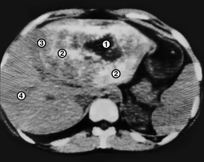 Рис. 4. Компьютерная томограмма при альвеолярном эхинококкозе печени: 1 — полость распада, 2 — ткань паразитарного узла, 3 — граница зоны поражения, 4 — ткань печени