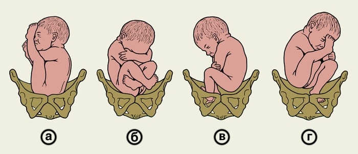 Схематическое изображение положения плода при различных видах тазового предлежания: а — чисто ягодичное (неполное) предлежание (ко входу в малый таз обращены ягодицы плода, ножки согнуты в тазобедренных суставах, разогнуты в коленных суставах и вытянуты вдоль туловища); б — смешанное ягодичное (полное) предлежание (ко входу в малый таз обращены ягодицы и стопы плода, ножки согнуты в тазобедренных и коленных суставах); в — полное ножное предлежание (ко входу в малый таз обращены обе стопы плода); г — неполное ножное предлежание (ко входу в малый таз обращена одна стопа плода)