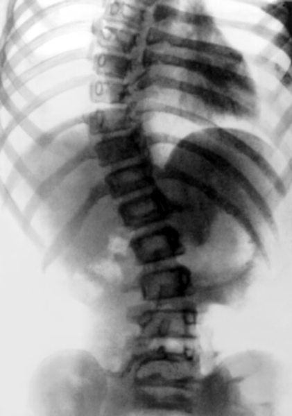 Рис. 4е). Диспластический сколиоз у девочки 12 лет: рентгенограмма позвоночника (прямая проекция) в положении больной лежа