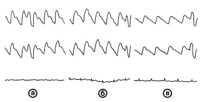 Рис. 1. Нормальные РЭГ у лиц разного возраста (а — 22 лет, б — 14 лет, в — 48 лет): сверху вниз — РЭГ правого полушария, РЭГ левого полушария, ЭКГ