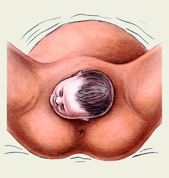 Рис. 4г). Схематическое изображение этапов периода изгнания плода при переднем виде затылочного предлежания плода (первая позиция): поворот головки плода личиком к правому бедру роженицы