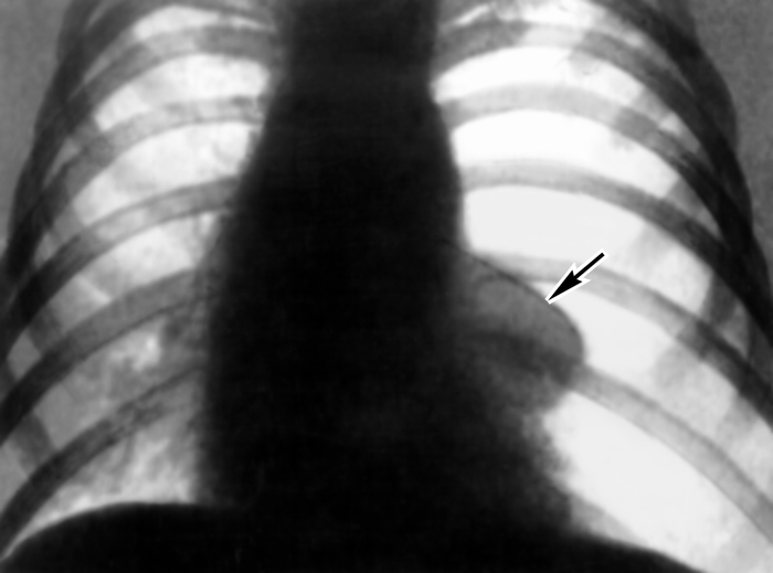 Рис. 2. Рентгенограмма органов грудной клетки при тотальном (полном) левостороннем пневмотораксе: прозрачность левой половины грудной клетки повышена, легочный рисунок отсутствует, к средостению прилежит тень полностью коллабированного легкого (указана стрелкой)